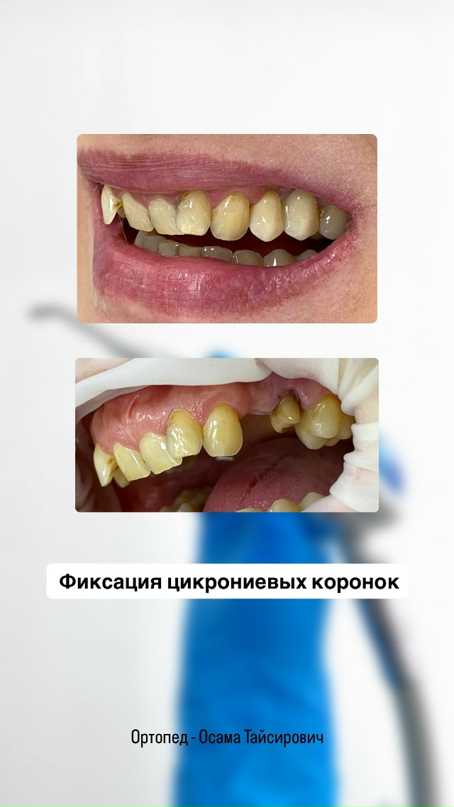 Фиксация циркониевых коронок — работа ортопеда Осамы Тайсировича